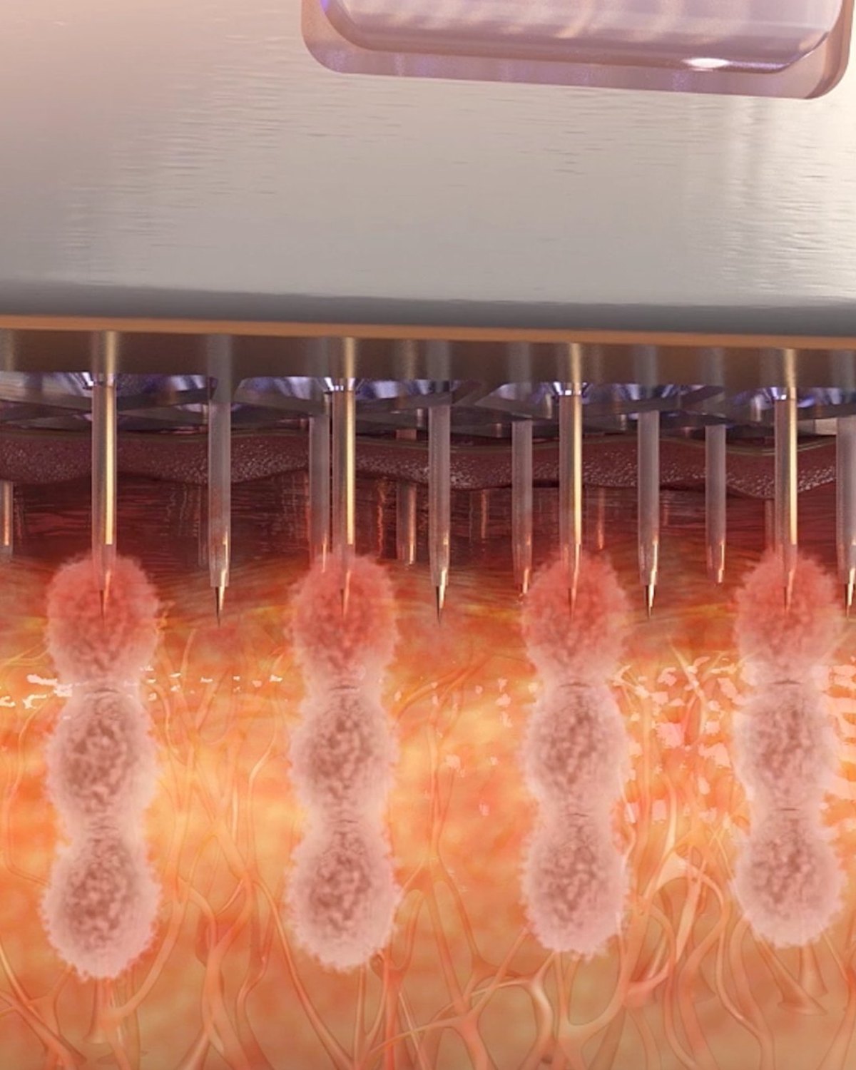 InMode diagram of Morpheus8 Burst microneedles delivering radiofrequency energy at three depths beneath the skin