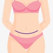 Tummy tuck by Dr. Carlos Mata in Scottsdale, AZ