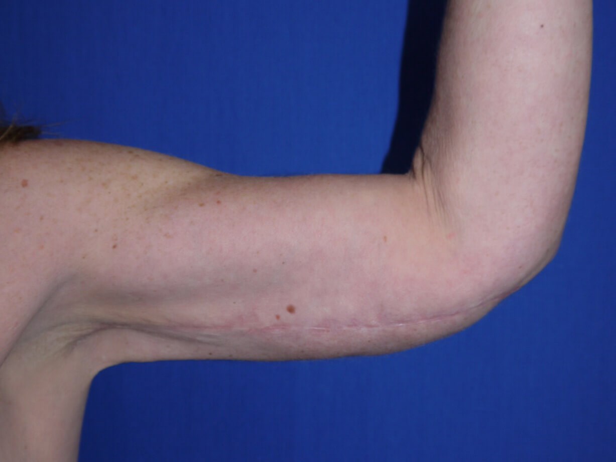 Case #17452 After left