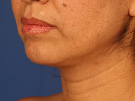 Case #17458 after left oblique