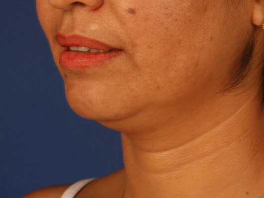 Case #17458 before left oblique