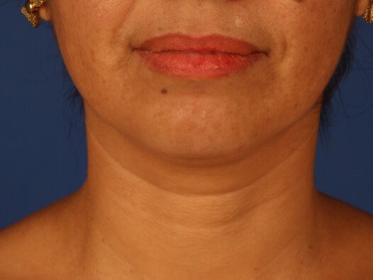 Case #17458 before