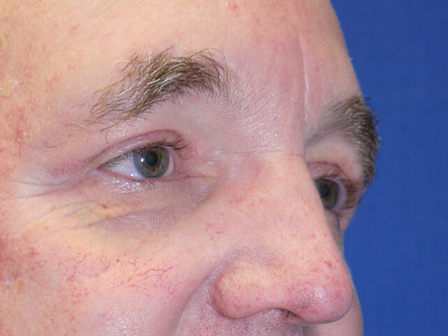 Case #17516 after right oblique