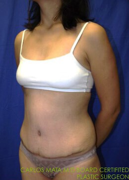 Case #17535 After left oblique