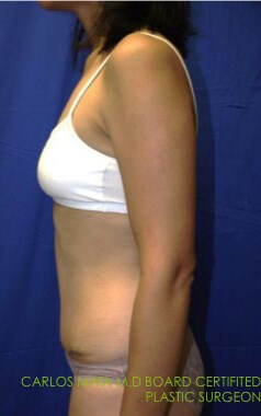 Case #17535 After left side
