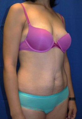 Case #17535 Before right oblique
