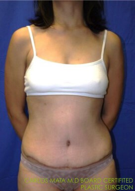 Case #17535 after front