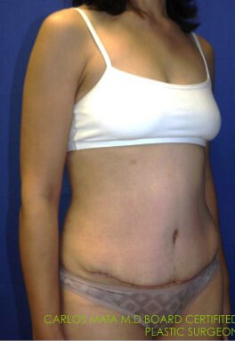 Case #17535 after right oblique