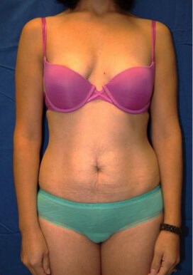 Case #17535 before front