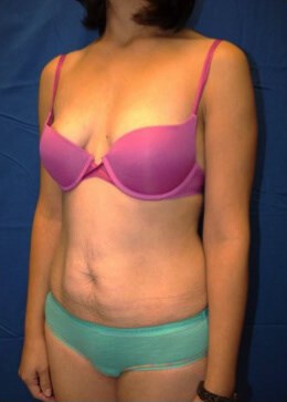 Case #17535 before left oblique