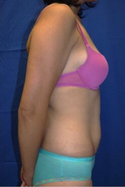 Case #17535 before right side