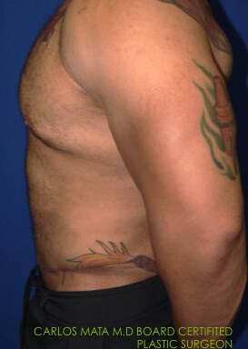 Case #17539 after left