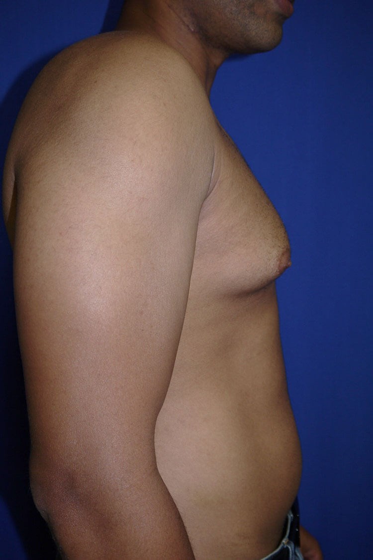 Case #17652 before right side