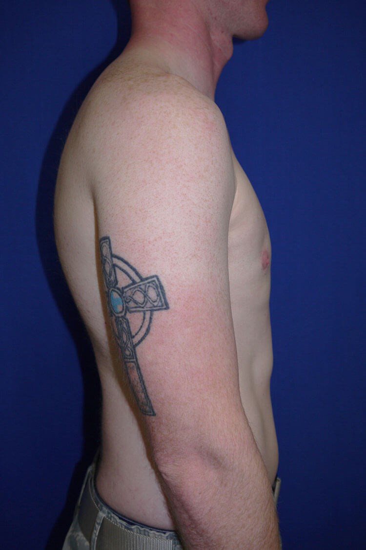 Case #17653 after right side