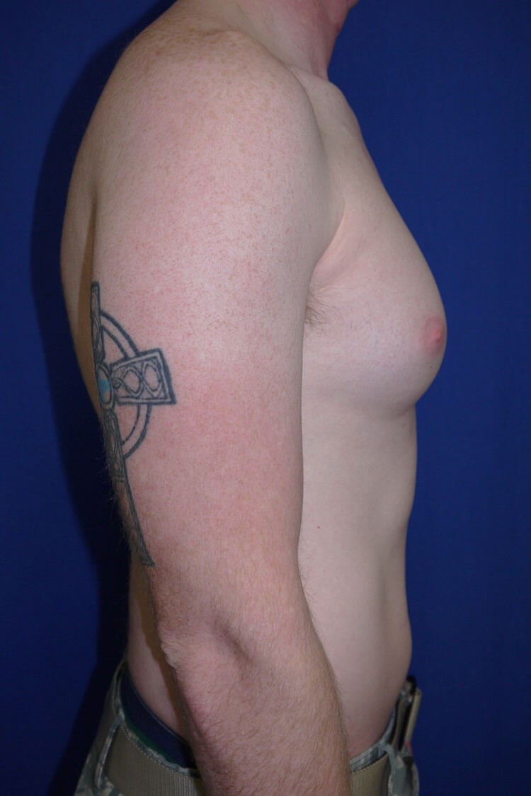 Case #17653 before right side