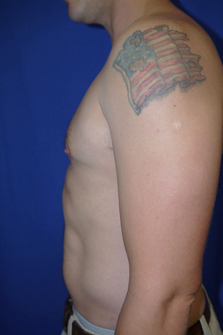 Case #17654 after left side