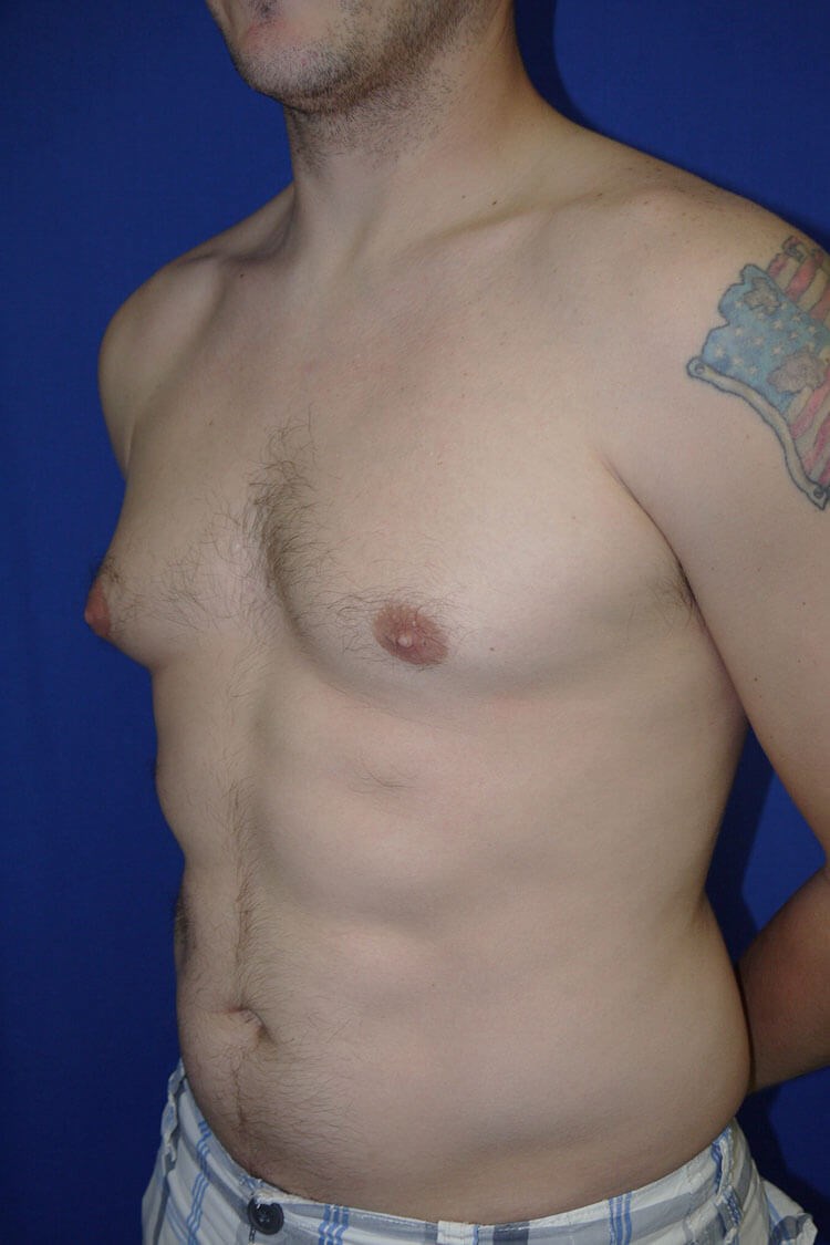 Case #17654 before left oblique