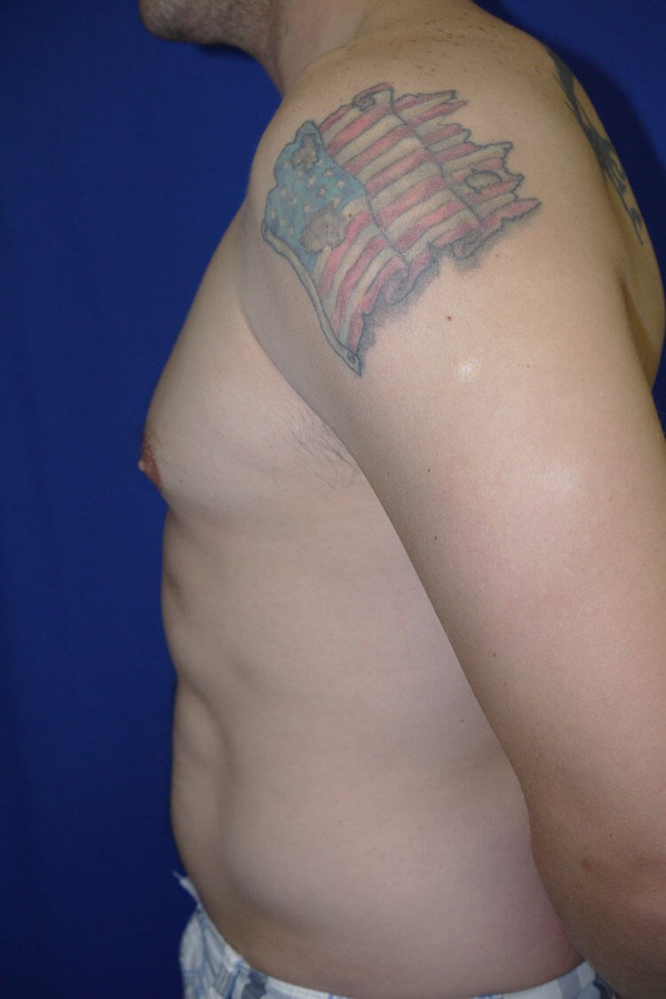 Case #17654 before left side