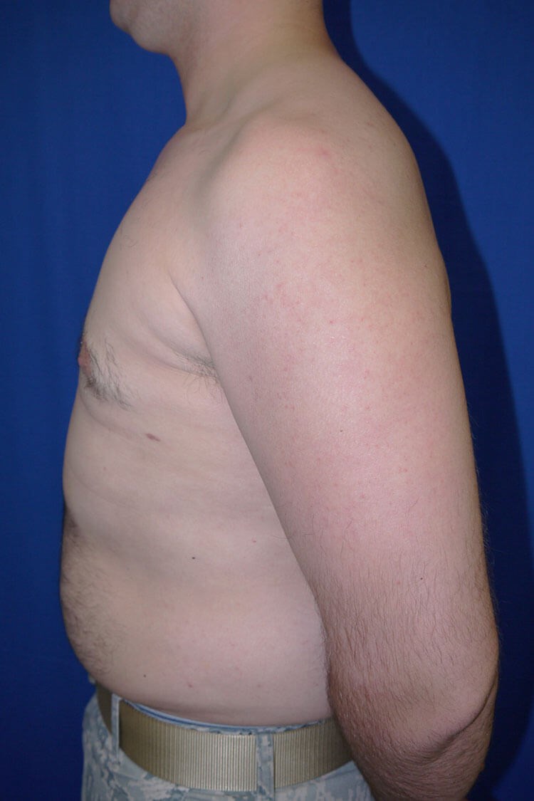 Case #17656 After left side
