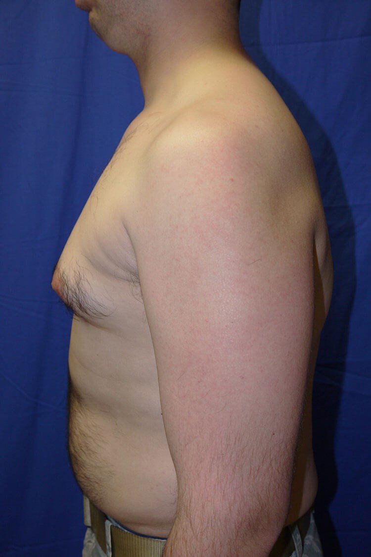 Case #17656 before left side