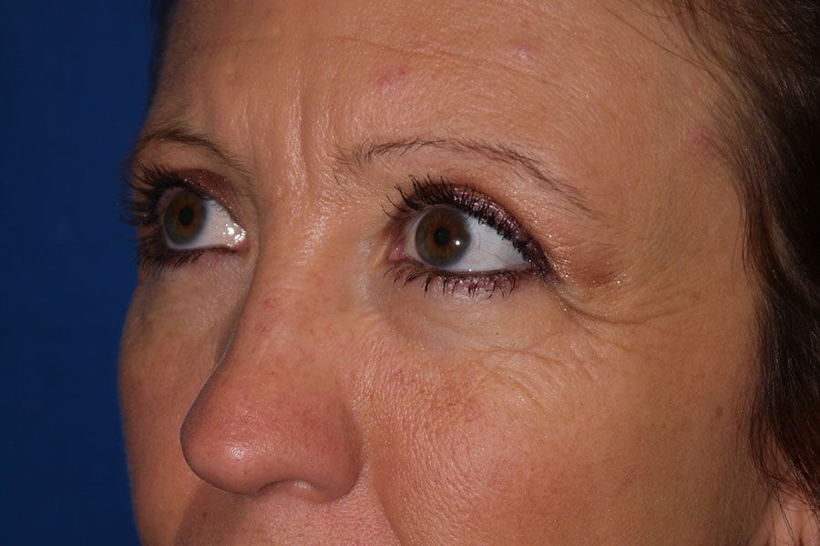 Case #17662 after left oblique