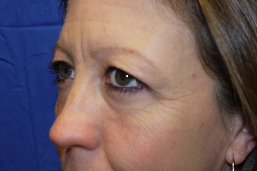 Case #17662 before left oblique