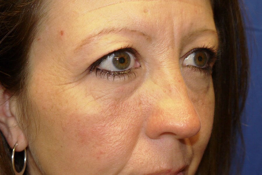 Case #17662 before right oblique
