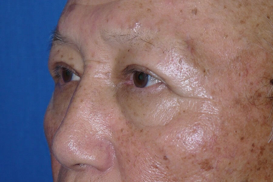 Case #17667 after left oblique