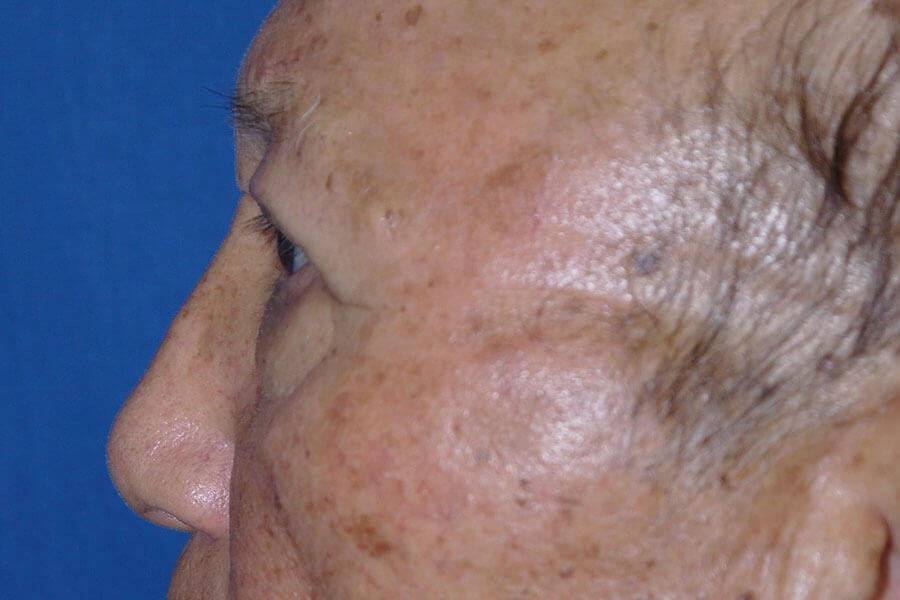 Case #17667 after left side