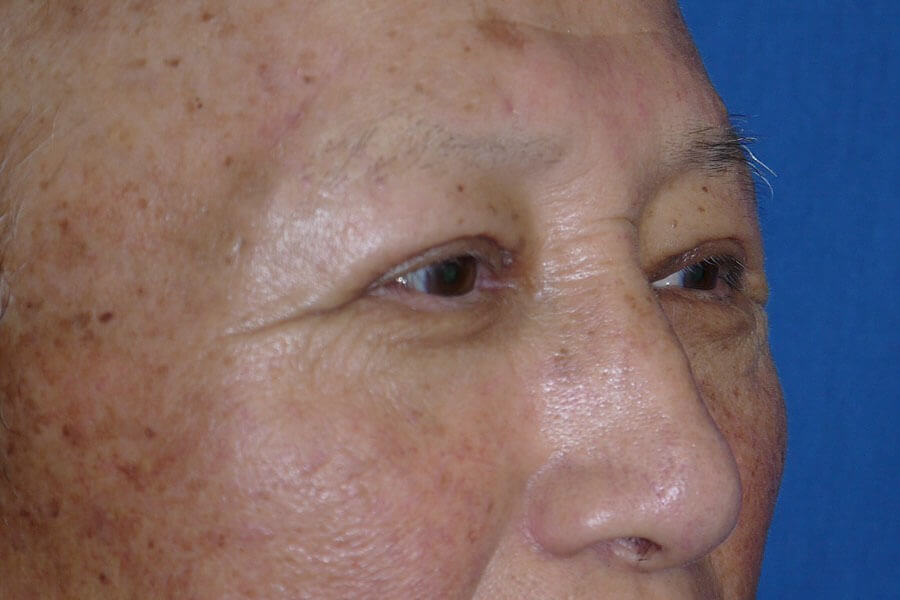 Case #17667 after right oblique