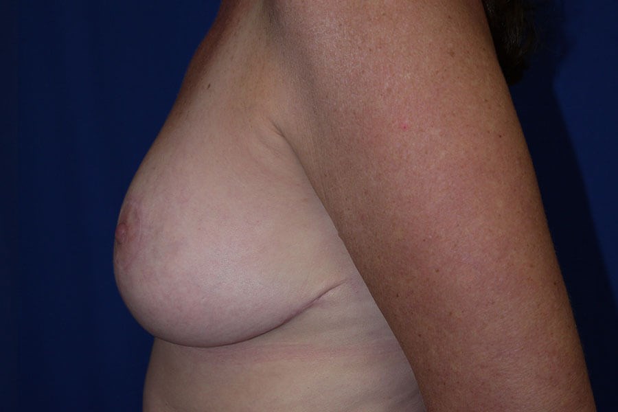 Case #17740 After left side