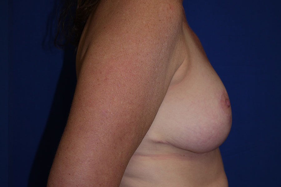 Case #17740 After right side'