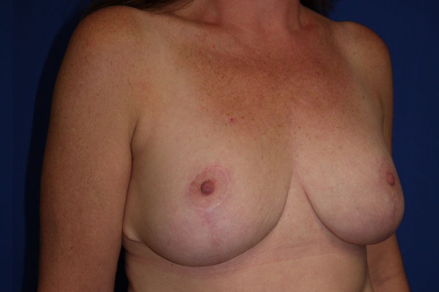 Case #17740 after right oblique