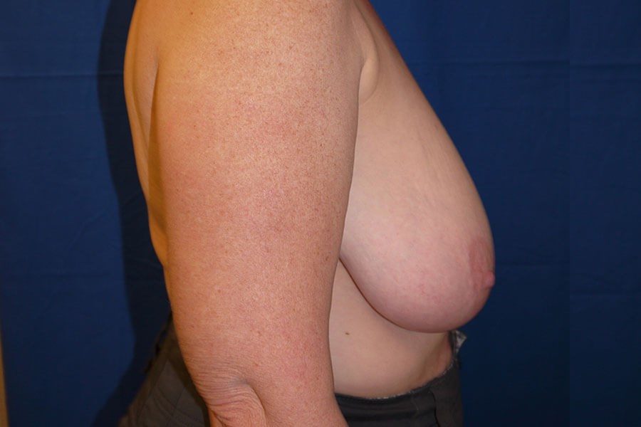 Case #17740 before right side