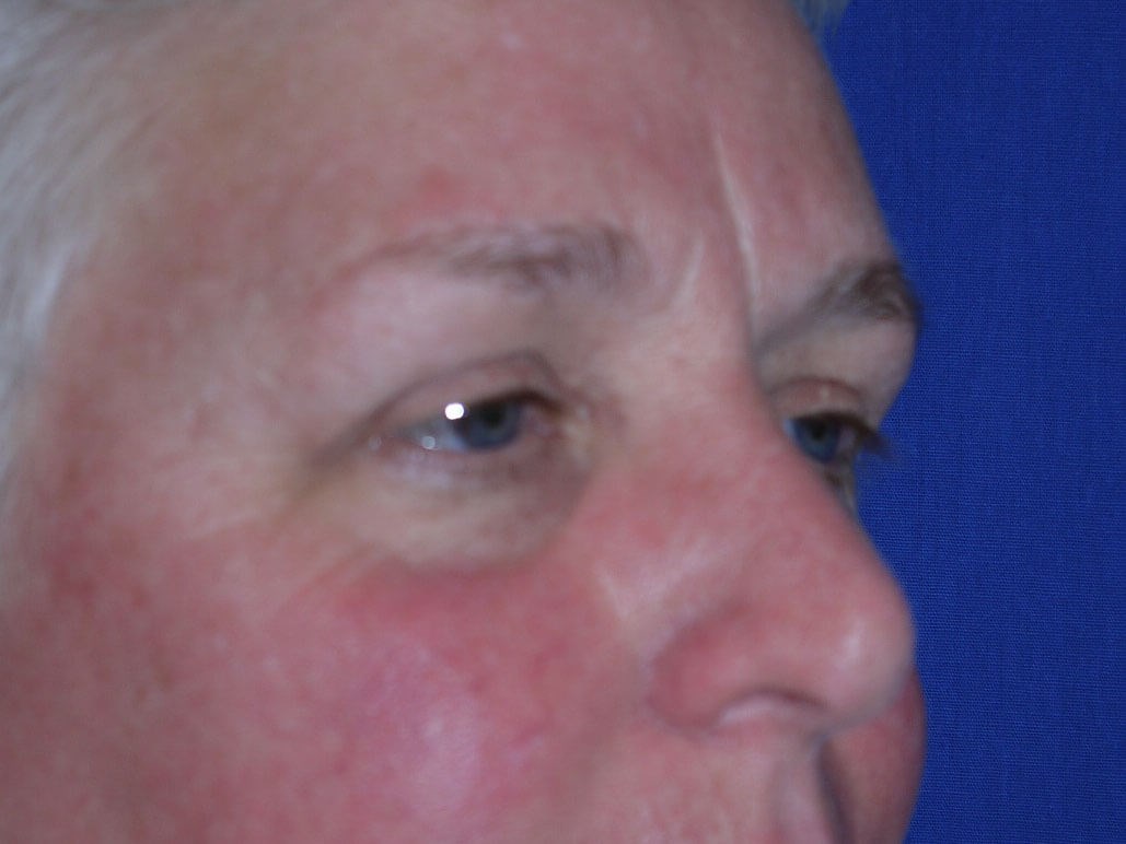Case #19079 before right oblique