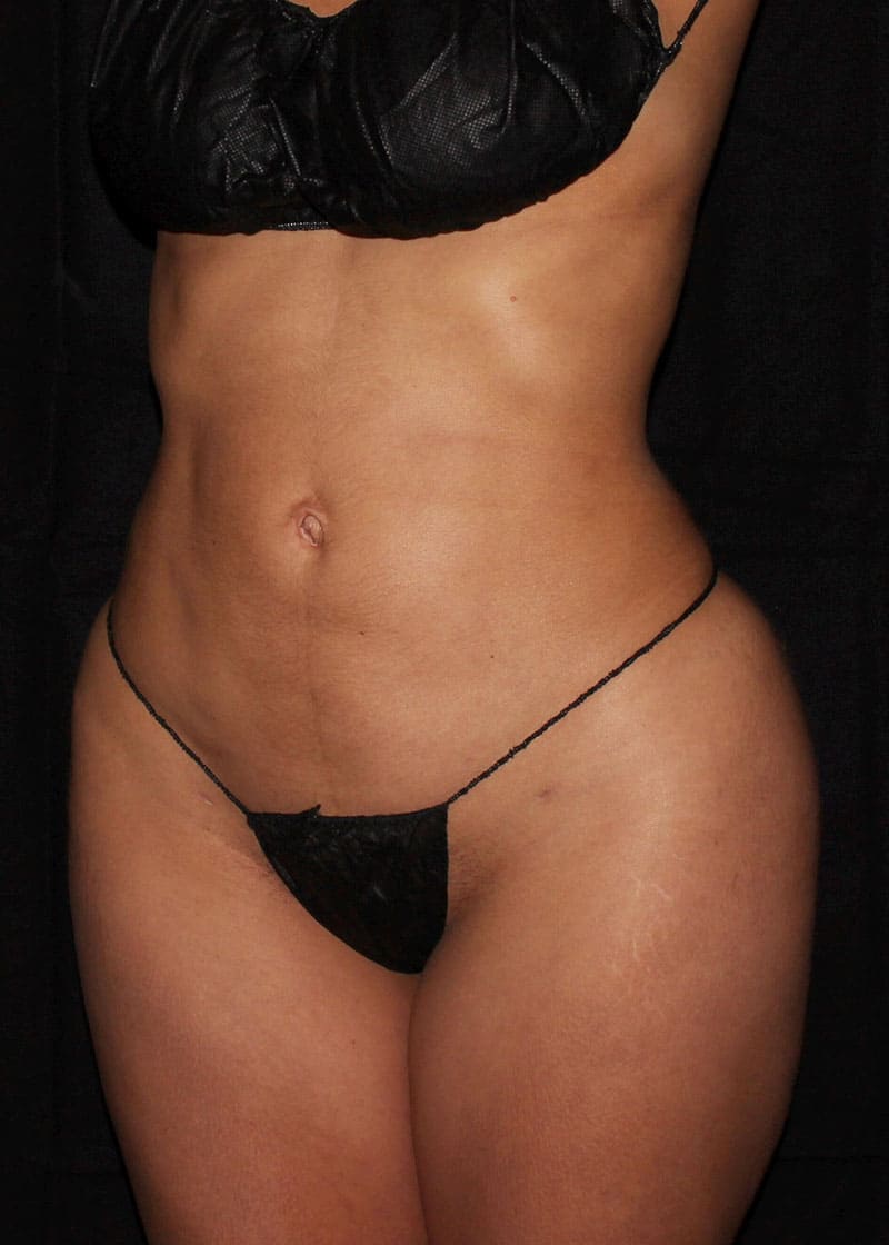 Case #34958 after left oblique