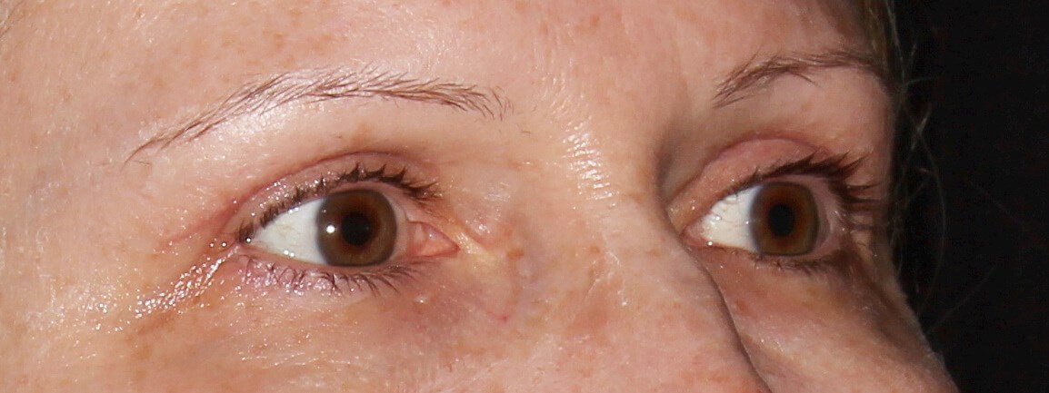 Case #35241 after right oblique